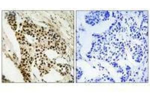 Immunohistochemistry analysis of paraffin-embedded human breast carcinoma tissue using MAPKAPK2 (Ab-272) antibody. (MAPKAP Kinase 2 Antikörper  (Ser272))