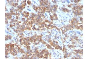 Formalin-fixed, paraffin-embedded human Parathyroid Mass stained with TNFS15 / VEGI Monoclonal Antibody (VEGI /1283). (TNFSF15 Antikörper)