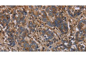 Immunohistochemistry of paraffin-embedded Human liver cancer using FLNA Polyclonal Antibody at dilution of 1:40 (Filamin A Antikörper)