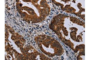 The image on the left is immunohistochemistry of paraffin-embedded Human gastic cancer tissue using ABIN7191351(MAGEB3 Antibody) at dilution 1/20, on the right is treated with synthetic peptide. (MAGEB3 Antikörper)
