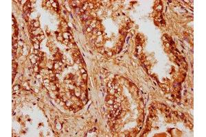 IHC image of ABIN7148132 diluted at 1:500 and staining in paraffin-embedded human prostate cancer performed on a Leica BondTM system. (CCDC6 Antikörper  (AA 347-440))