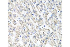 Immunohistochemistry of paraffin-embedded Human liver damage using OTC Polyclonal Antibody at dilution of 1:100 (40x lens). (OTC Antikörper)