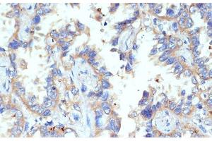 Immunohistochemistry of paraffin-embedded Human lung cancer using CD47 Polyclonal Antibody at dilution of 1:200 (40x lens). (CD47 Antikörper)