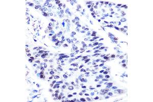 Immunohistochemistry of paraffin-embedded human esophageal cancer using p63 antibody (ABIN3023011, ABIN3023012, ABIN3023013, ABIN1513632 and ABIN6219346) at dilution of 1:50 (40x lens).