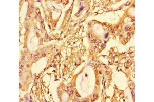 Immunohistochemistry of paraffin-embedded human pancreatic cancer using ABIN7172704 at dilution of 1:100 (SUPT3H/SPT3 Antikörper  (AA 1-328))