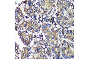 Immunohistochemistry of paraffin-embedded Human liver cancer using SENP1 Rabbit pAb (ABIN6132646, ABIN6147534, ABIN6147536 and ABIN6216945) at dilution of 1:100 (40x lens). (SENP1 Antikörper  (AA 220-420))