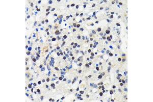 Immunohistochemistry of paraffin-embedded human oophoroma using Cullin 3 antibody (ABIN7266543) at dilution of 1:100 (40x lens).