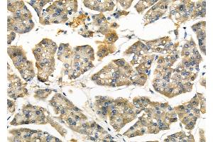 ABIN6262447 and ABIN6266925 at 1/100 staining Human pancreatic cancer and adjacent nomal tissues by IHC-P. (EIF3L Antikörper  (N-Term))