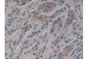 DAB staining on IHC-P; Samples: Human Prostate cancer Tissue (CD1e Antikörper  (AA 39-276))