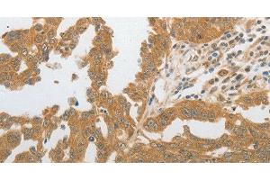 Immunohistochemistry of paraffin-embedded Human ovarian cancer tissue using GRIN2C Polyclonal Antibody at dilution 1:80 (GRIN2C Antikörper)