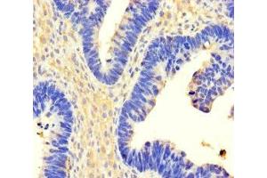 Immunohistochemistry of paraffin-embedded human ovarian cancer using ABIN7174304 at dilution of 1:100 (USP3 Antikörper  (C-Term))