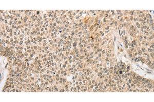 Immunohistochemistry of paraffin-embedded Human lung cancer tissue using RPL26L1 Polyclonal Antibody at dilution 1:30 (RPL26L1 Antikörper)