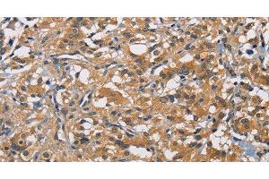 Immunohistochemistry of paraffin-embedded Human thyroid cancer tissue using PIKFYVE Polyclonal Antibody at dilution 1:50 (PIKFYVE Antikörper)