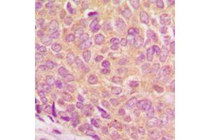 Immunohistochemical analysis of Ataxin 1 (pS775) staining in human breast cancer formalin fixed paraffin embedded tissue section. (Ataxin 1 Antikörper  (C-Term, pSer775))