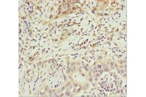 Immunohistochemistry of paraffin-embedded human bladder cancer using ABIN7144897 at dilution of 1:100 (ABCB8 Antikörper  (AA 486-735))