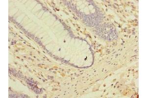 Immunohistochemistry of paraffin-embedded human colon cancer using ABIN7158150 at dilution of 1:100 (LRRC2 Antikörper  (AA 1-371))
