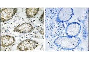 Immunohistochemistry analysis of paraffin-embedded human colon carcinoma, using ATR (Phospho-Ser428) Antibody. (ATR Antikörper  (pSer428))