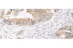 Immunohistochemistry of paraffin-embedded Human colorectal cancer tissue using IDUA Polyclonal Antibody at dilution of 1:35(x200) (IDUA Antikörper)
