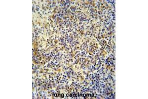 KRI1 antibody (N-term) immunohistochemistry analysis in formalin fixed and paraffin embedded human lung carcinoma followed by peroxidase conjugation of the secondary antibody and DAB staining.