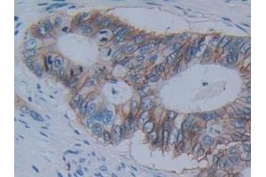 Detection of CDH17 in Human Colorectal cancer Tissue using Polyclonal Antibody to Cadherin 17 (CDH17) (LI Cadherin Antikörper  (AA 67-351))