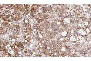 ABIN6279837 at 1/100 staining Human liver cancer tissue by IHC-P.