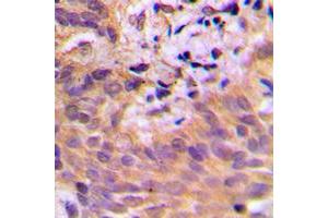 Immunohistochemical analysis of CDKL2 staining in human breast cancer formalin fixed paraffin embedded tissue section. (CDKL2 Antikörper  (Center))