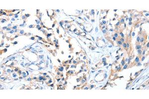 Immunohistochemistry of paraffin-embedded Human esophagus cancer using AOX1 Polyclonal Antibody at dilution of 1:65 (AOX1 Antikörper)