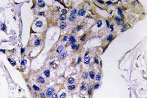 Immunohistochemistry (IHC) analyzes of IL-5 antibody in paraffin-embedded human breast carcinoma tissue. (IL-5 Antikörper)