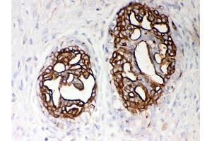 Anti- PKM2 Picoband antibody, IHC(P) IHC(P): Human Mammary Cancer Tissue (PKM Antikörper  (N-Term))
