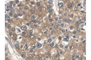 DAB staining on IHC-P; Samples: Human Prostate cancer Tissue (ALDOA Antikörper  (AA 18-273))