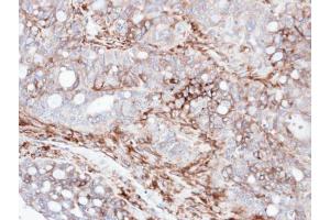IHC-P Image Immunohistochemical analysis of paraffin-embedded human serous ovarian cancer, using AKAP12, antibody at 1:100 dilution. (AKAP12 Antikörper  (C-Term))