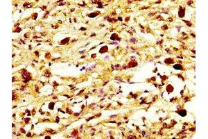 IHC image of ABIN7160588 diluted at 1:800 and staining in paraffin-embedded human melanoma performed on a Leica BondTM system. (MYH7 Antikörper  (AA 1802-1915))