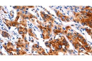 Immunohistochemistry of paraffin-embedded Human lung cancer tissue using SEPT4 Polyclonal Antibody at dilution 1:50 (Septin 4 Antikörper)