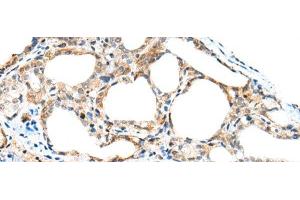 Immunohistochemistry of paraffin-embedded Human thyroid cancer tissue using SPACA3 Polyclonal Antibody at dilution of 1:45(x200) (SPACA3 Antikörper)