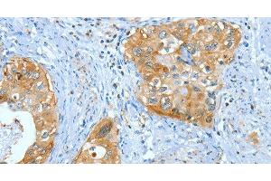 Immunohistochemistry of paraffin-embedded Human cervical cancer using ANXA3 Polyclonal Antibody at dilution of 1:35 (Annexin A3 Antikörper)