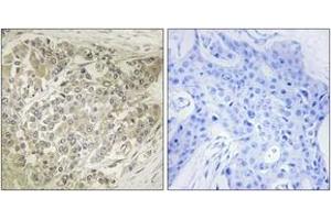 Immunohistochemistry analysis of paraffin-embedded human breast carcinoma tissue, using p70 S6 Kinase (Ab-424) Antibody. (RPS6KB1 Antikörper  (AA 414-463))