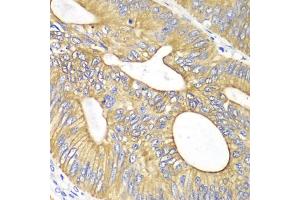 Immunohistochemistry of paraffin-embedded human colon carcinoma using VEGFB antibody (ABIN5971159) at dilution of 1/100 (40x lens). (VEGFB Antikörper)