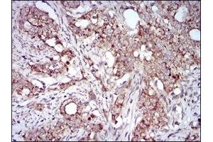 Immunohistochemical analysis of paraffin-embedded human cervical cancer tissues using GAB2 mouse mAb with DAB staining. (GAB2 Antikörper  (AA 332-476))