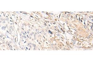 Immunohistochemistry of paraffin-embedded Human prost ate cancer tissue using NREP Polyclonal Antibody at dilution of 1:35(x200) (NREP Antikörper)