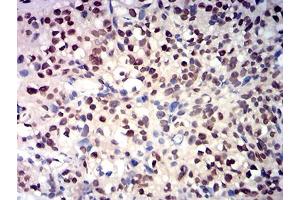 Immunohistochemical analysis of paraffin-embedded bladder cancer tissues using RBBP7 mouse mAb with DAB staining. (RBBP7 Antikörper  (AA 1-200))