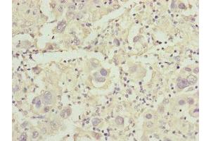 Immunohistochemistry of paraffin-embedded human liver cancer using ABIN7149016 at dilution of 1:100