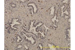 Immunoperoxidase of monoclonal antibody to EML4 on formalin-fixed paraffin-embedded human prostate cancer.