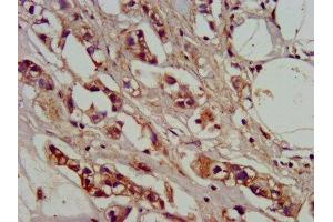 IHC image of ABIN7142146 diluted at 1:400 and staining in paraffin-embedded human breast cancer performed on a Leica BondTM system. (ADO Antikörper  (AA 137-270))