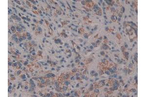 DAB staining on IHC-P; Samples: Human Prostate cancer Tissue (CD109 Antikörper  (AA 1146-1390))