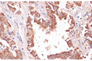 Immunohistochemistry of paraffin-embedded Human lung cancer using KCNH2 Polyclonal Antibody at dilution of 1:100 (40x lens). (KCNH2 Antikörper)