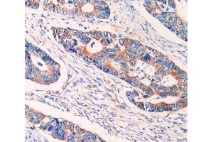 IHC-P analysis of rectum cancer tissue, with DAB staining. (ECT2 Antikörper  (AA 166-348))