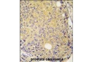 Forlin-fixed and paraffin-embedded hun prostata carcino tissue reacted with P3K5 ANtibody  g , which was peroxidase-conjugated to the secondary antibody, followed by DAB staining. (ASK1 Antikörper  (AA 821-849))