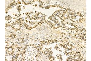 STAT5B Mouse Monoclonal Antibody at 1/100 staining human ovarian cancer by IHC-P. (STAT5B Antikörper  (C-Term))