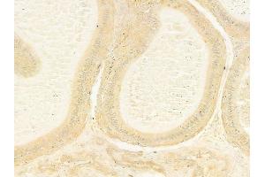 ABIN6264583 and ABIN6279744 at 1/100 staining human testicular cancer by IHC-P.
