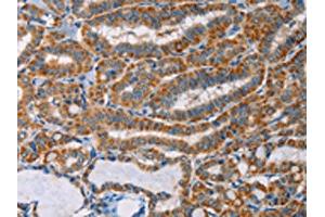 The image on the left is immunohistochemistry of paraffin-embedded Human thyroid cancer tissue using ABIN7128293(AGPAT4 Antibody) at dilution 1/25, on the right is treated with fusion protein. (AGPAT4 Antikörper)